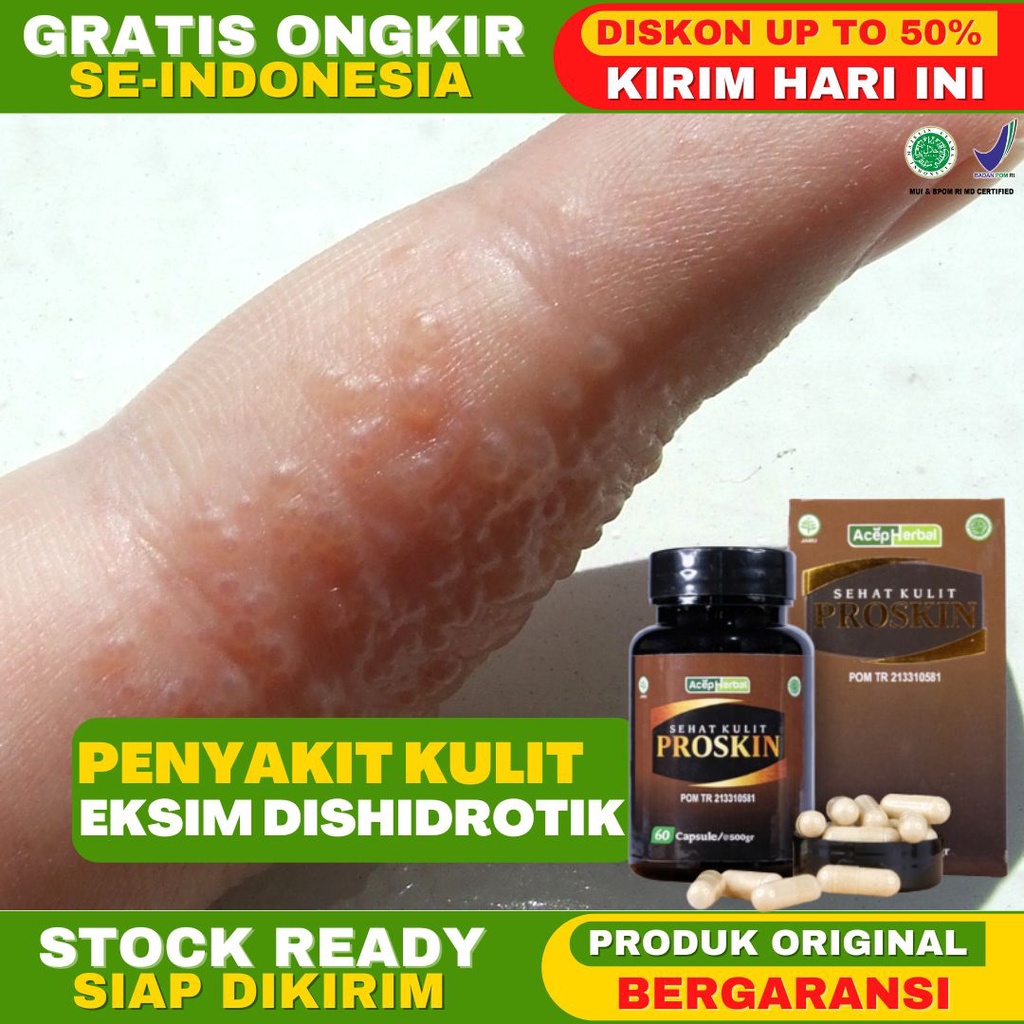 Obat Eksim Dishidrotik Kulit Melepuh Berisi Cairan Gatal Gatal Alergi Sensasi Terbakar Lepuhan Di Ka