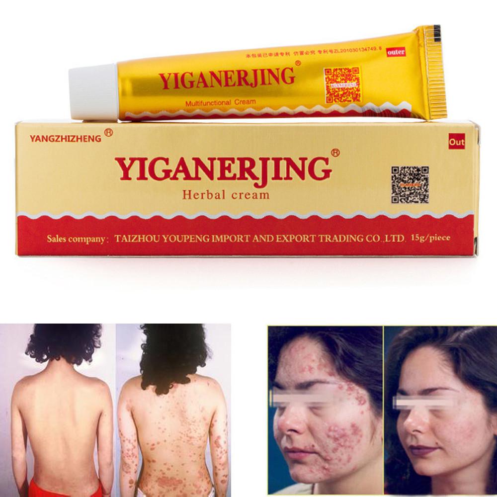 Yiganerjing Korea Herbal Alami Herbal Cream untuk Psoriasis Eksim Jerawat Gatal 15G