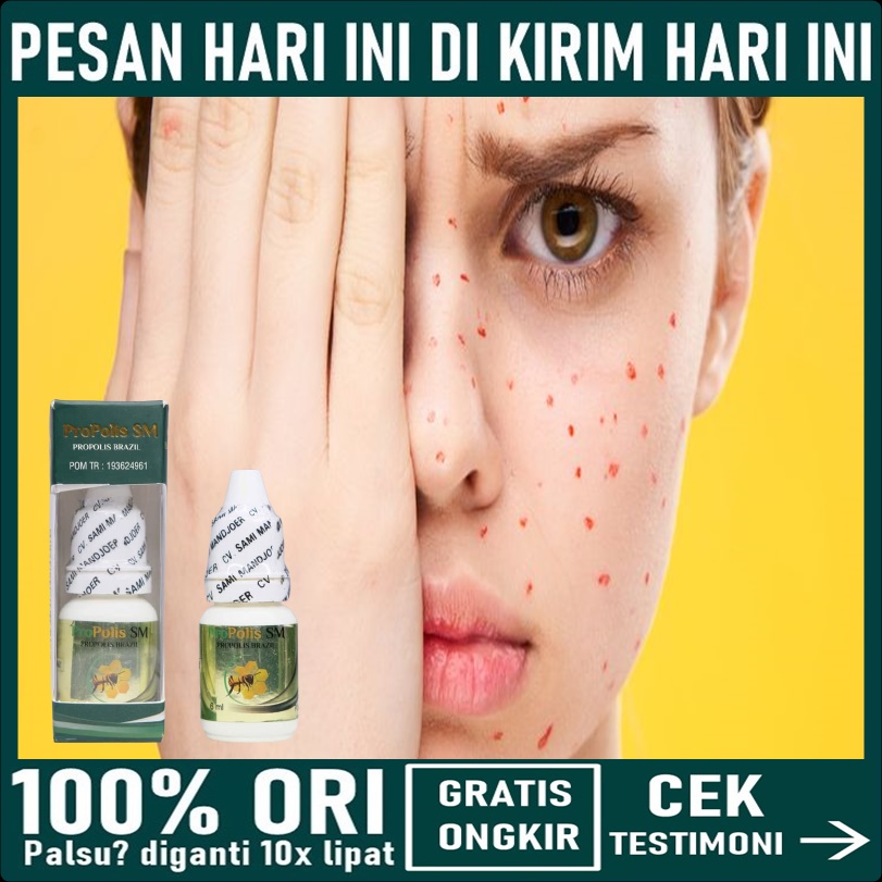 Obat Campak Dewasa - Obat Cacar air dewasa - Obat Penghilang bekas cacar - Salep cacar api / ular - 