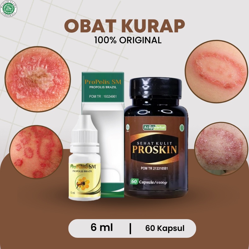 Proskin - Obat Kurap, Obat Kudis, Salep kurap kadas kudis gatal kering, Obat kadas kurap, Obat eksim