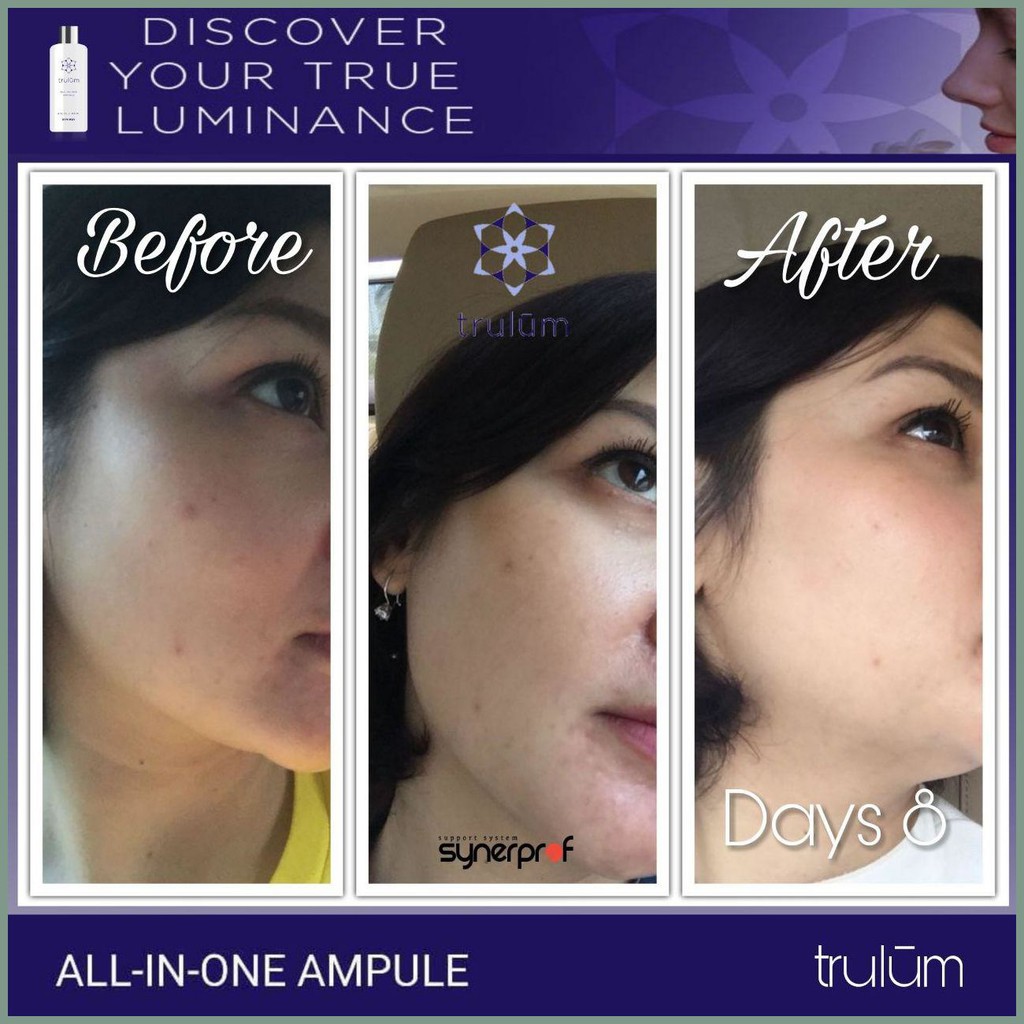 [890$ Pemutih Wajah Ampuh / Skincare Untuk Menghilangkan Flek Hitam Di Hidung Dan Diatas Bibir