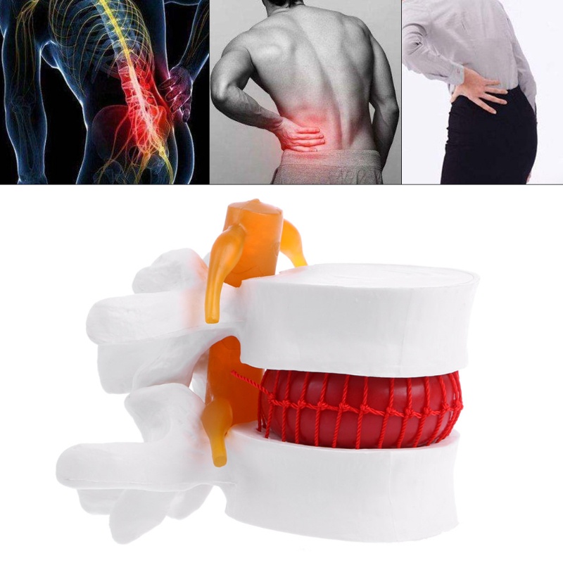 Mary Human Anaatomical Lumbar Disc Model Herniasi Alat Bantu Belajar Medis Instrumen Anatomi