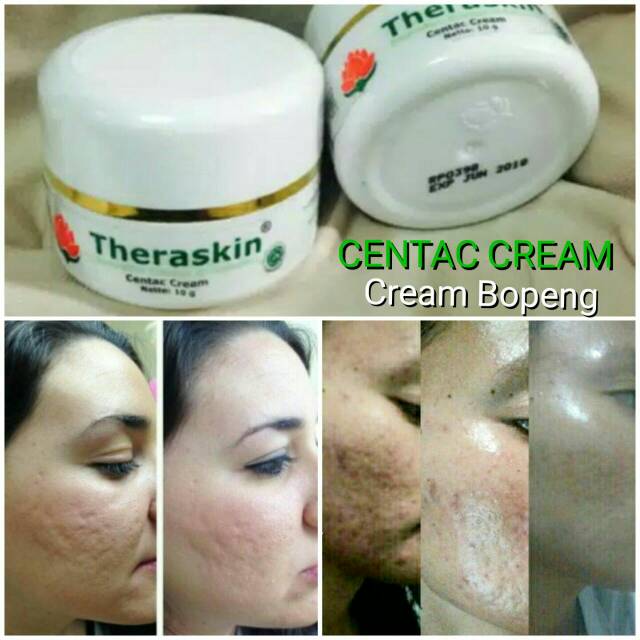 THERASKIN CENTAC CREAM ORIGINAL 100% -  PENGHILANG BOPENG / WAJAH BERLOBANG / BEKAS CACAR / JERAWAT