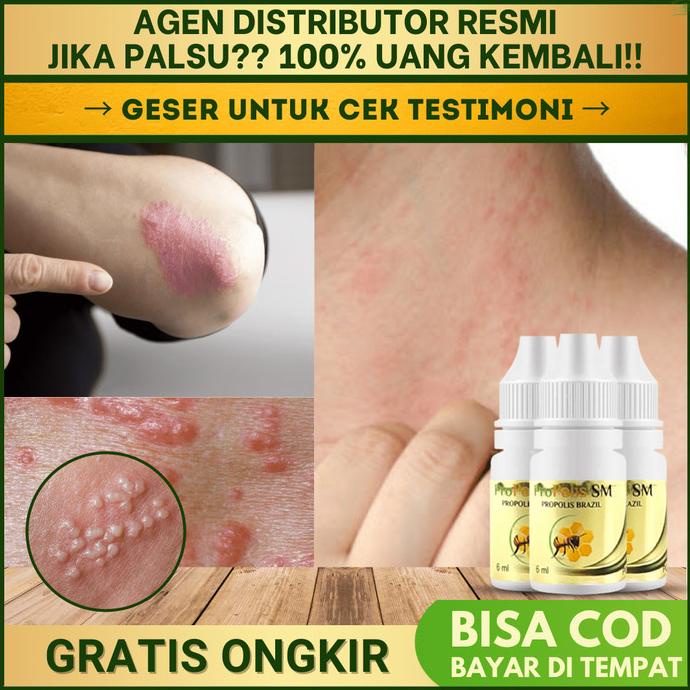 

BAYAR DITEMPAT Obat Gatal Kulit Menahun Herbal Infeksi Jamur Alergi Propolis SM /OBAT HERBAL ASAM URAT/OBAT HERBAL PELANGSING/OBAT HERBAL KOLESTEROL/OBAT HERBAL DIABETES