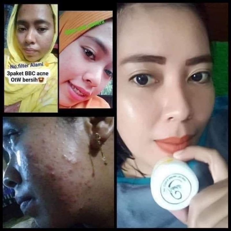 BEBWHITE C BBC ACNE SERIES UNTUK PEMULA DAN BERJERAWAT