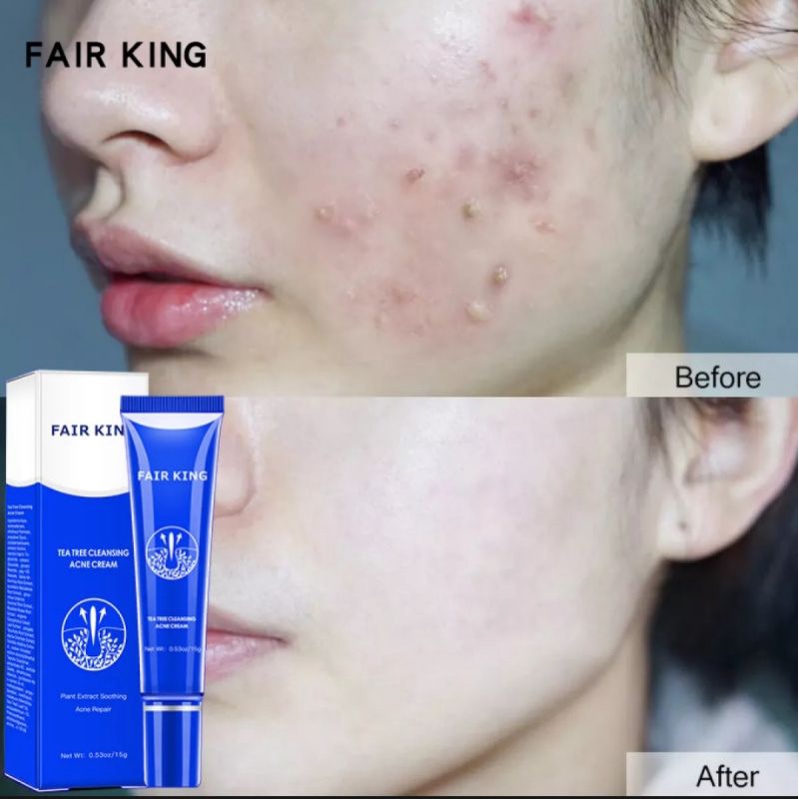 Fair king tea tree cleansing acne cream  obat jerawat komedo
