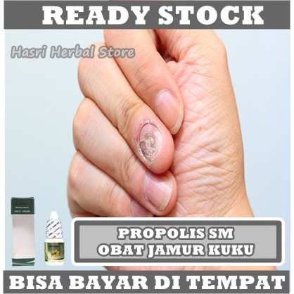 Obat Jamur Kuku - Salep Kuku Berjamur, Obat Kuku Rusak, Obat Kuku Kering, Obat Kuku Kuning, Obat Kuku Mengeras, Obat Kuku Rapuh, Obat Tetes Kuku Cantengan, Obat Kekeongeun, Obat Kuku Bengkak, Obat Kuku Bernanah Dan Bau Dengan Herbal Propolis SM ASLI