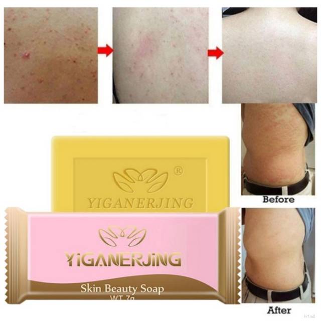 Anti Bakteri Sabun Gatal Yiganerjing Sulfur