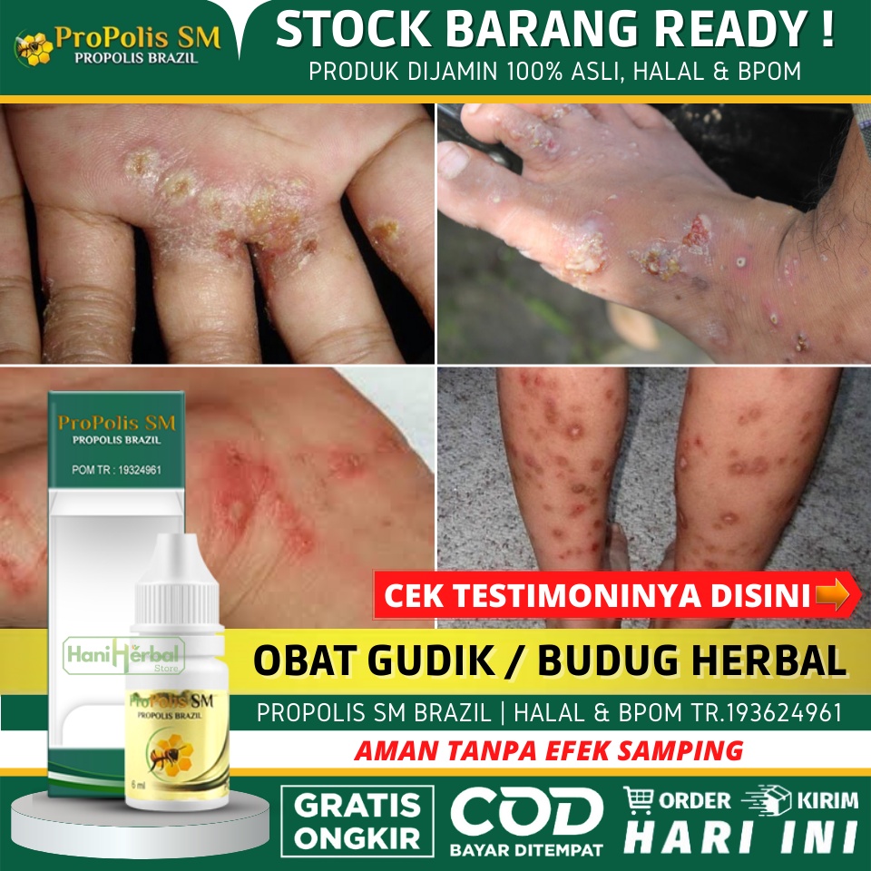 Obat Herbal Untuk Budug dan Gatal, Obat Budug Santri, Obat Budug Bernanah, Obat Gatal Bernanah, Gudi