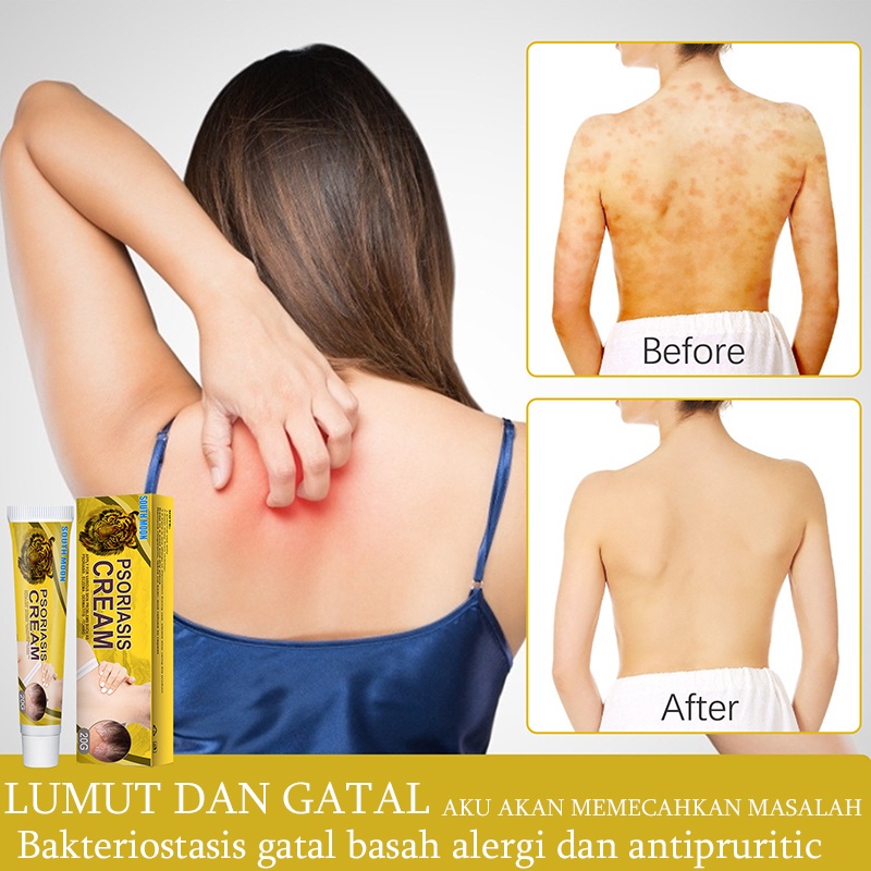 Salep Gatal Obat Gatal Kulit 20g Kulit Kepala Psoriasis Tangan Tinea Kaki Bau Versicolor Menghambat Dermatitis Jamur Salep Gatal Paling Ampuh