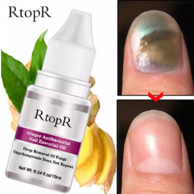 Obat Penghilang Jamur Kuku Mengatasi Kuku Petot