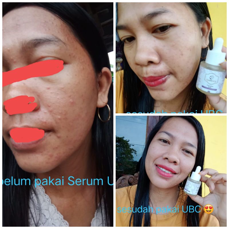 SERUM ACNE SERUM JERAWAT UBC ACNE SPOT SERUM BPOM