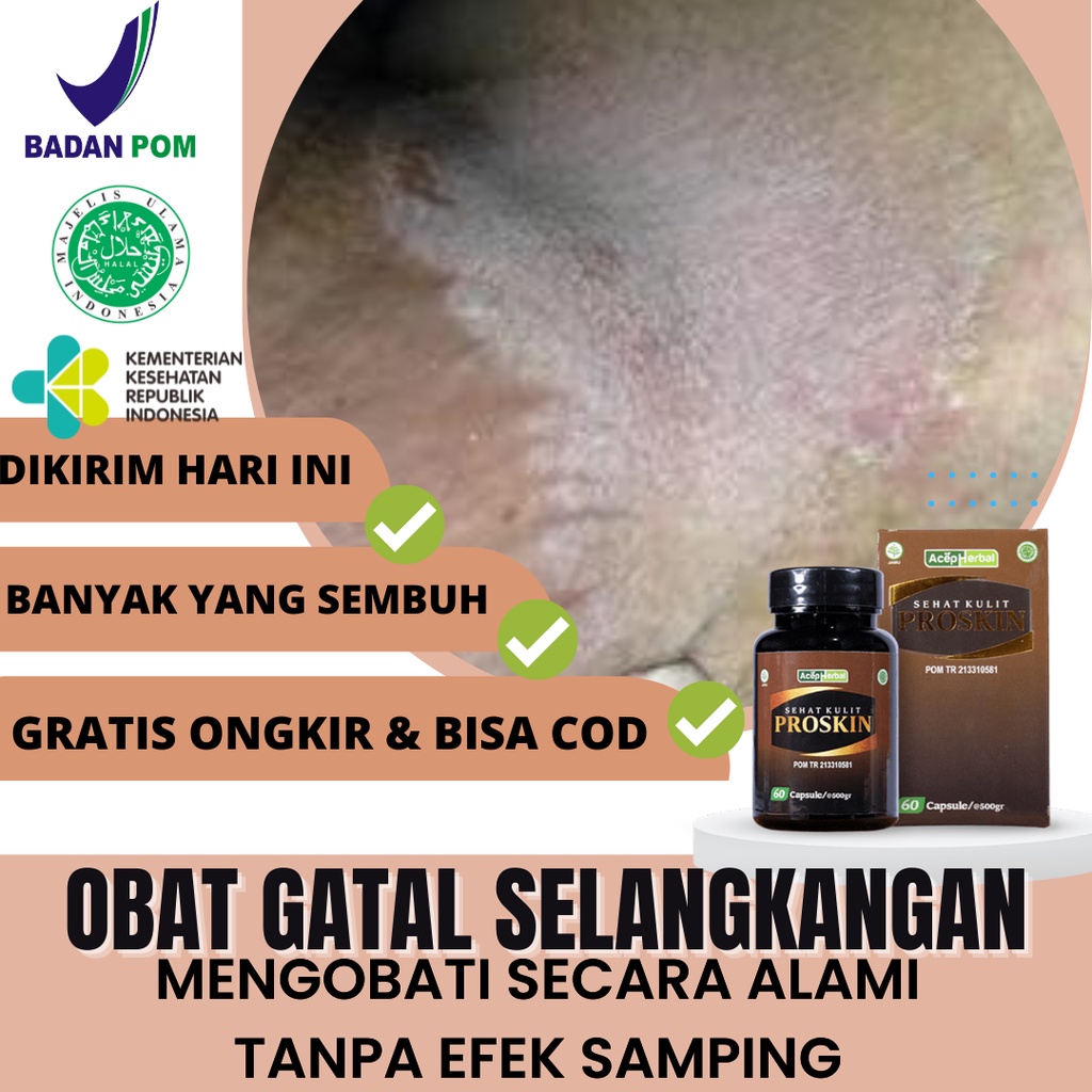 Obat Gatal Selangkangan, Gatel Selangkangan, Gatal di area selangkangan, Obat Selangkangan Gatal Dan