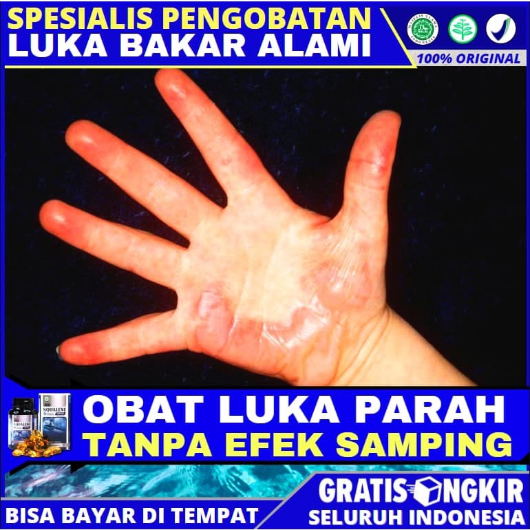 

Obat Luka Bakar Alami Untuk Pengering Luka Basah Diabetes Luka Bekas Pasca Operasi Caesar Luka Dalam Buat Menghilangkan Bekas Luka Borok Bernanah Penghilang Bekas Luka Hitam Keloid Koreng Korengan Herbal Suplemen Kesehatan Kulit Bio Squalene Minyak Ikan