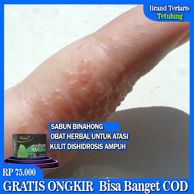 Obat Dishidrosis Di Telapak Tangan, Obat Khusus Untuk Eksim Dishidrosis, Obat Dishidrosis Sela-sela 