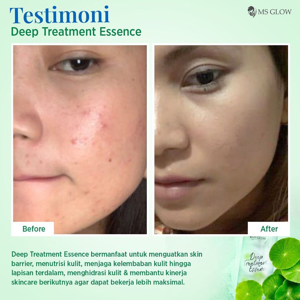 Ms Glow Deep Treatment Essence Mencerahkan Dan Menghilangkan Jerawat Shopee Indonesia