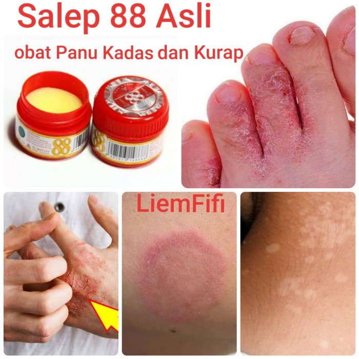 SALEP 88 // SALEP KULIT // SALEP KADAS KURAP // SALAP GATAL 6 G