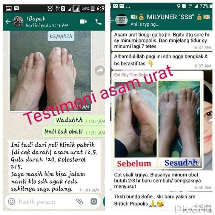 Propolis British Propolis Murni 100%Asli Obat Herbal Diabetes, Asam Urat Dan Kolesterol By IPPHO