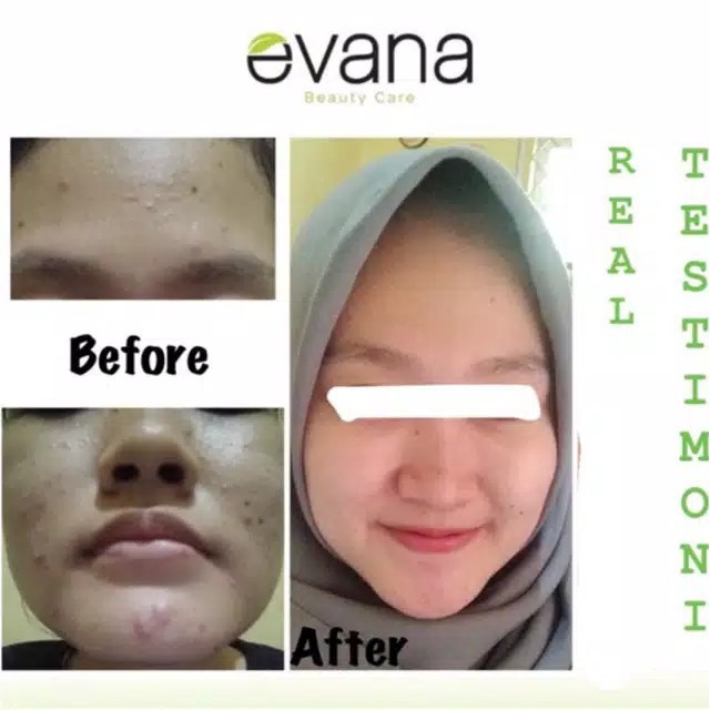 EVANA BEAUTY CARE - PAKET JERAWAT - JERAWAT- JERAWAT HILANG BPOM