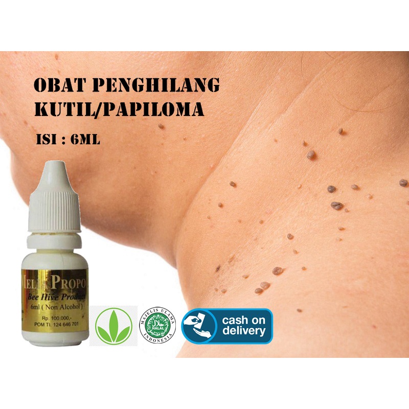 Obat Perontok Kutil Penghilang Papiloma di Leher - Obat Herbal Papiloma - Obat Penghilang Kutil