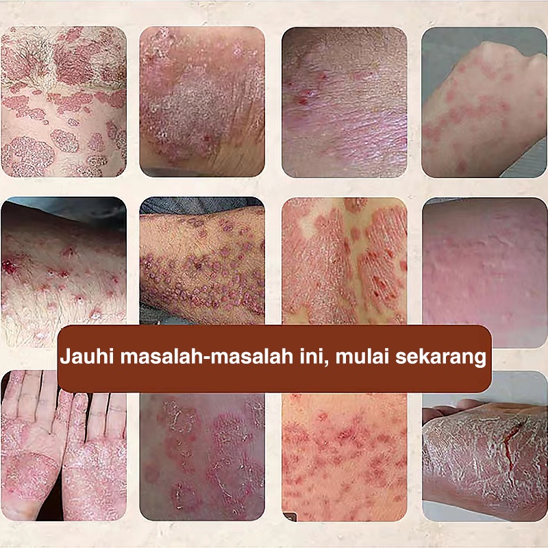 Salep gatal Salep Eksim Salep kulit Krim psoriasis paling ampuh Kulit Kepala Psoriasis Tangan Tinea Kaki Bau Versicolor Menghambat Dermatitis Jamur Anti Gatal Cream 30G