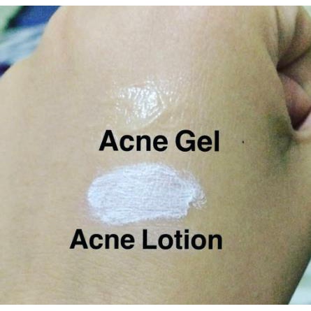 * NCC * Viva Acne Lotion Gel Whitening Cream Penghambat Jerawat pada Wajah Anti Acne