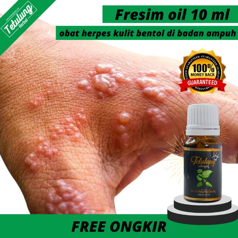 Tetulung Binahong Fresim Oil Obat Herpes Di Badan - Obat Herpes Autoimun - Obat Psoriaris Herpes - O