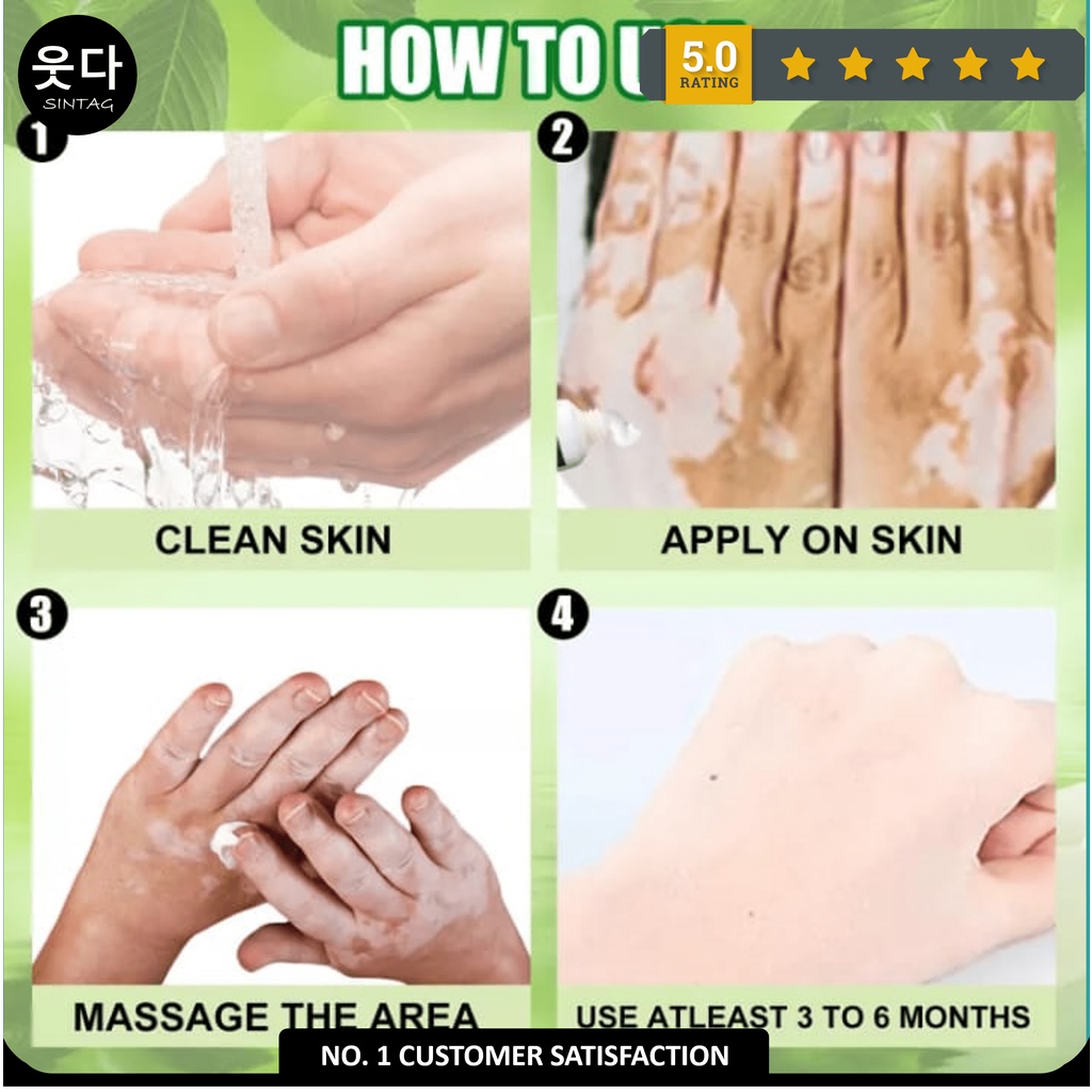 Obat Salep Vitiligo Eelhoe Krim Herbal Penghilang Bintik Putih