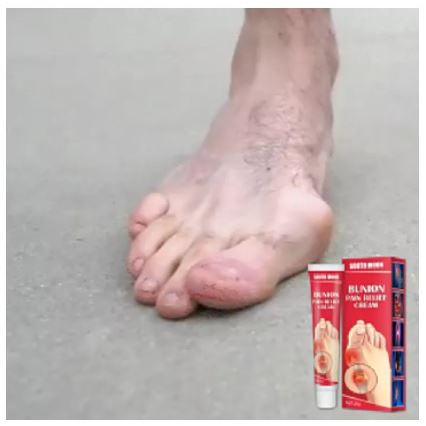 Salep Bunion Pain Relief Cream Splint Jari Kaki Hallux Valgus Pengobatan Arthritis Lutut, Pereda Nyeri Pada Sendi