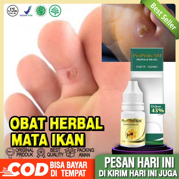 Jual Obat Mata Ikan Penghilang Mata Ikan Mata Ikan Di Kaki Mata Ikan Di Telapak Kaki