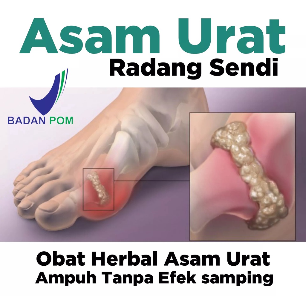 

Naturatik Atasi Asam Urat, rematik, pegel linu/Obat herbal atasi tanpa operasi/Obat herbal asli/obat herbal tanpa bahan kimia/obat herbal bpom/obat herbal langsung pabrik