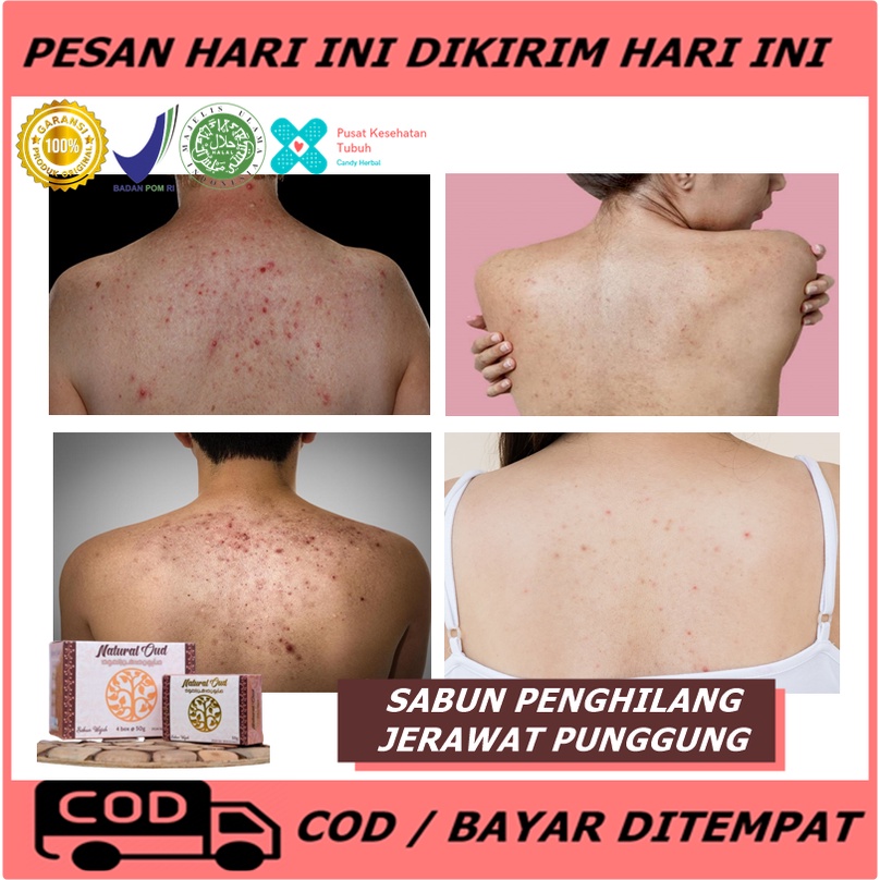 Sabun Jerawat Punggung, Leher, Wajah - Sabun Penghilang Jerawat dan Bekas Jerawat - Obat Penghilang 