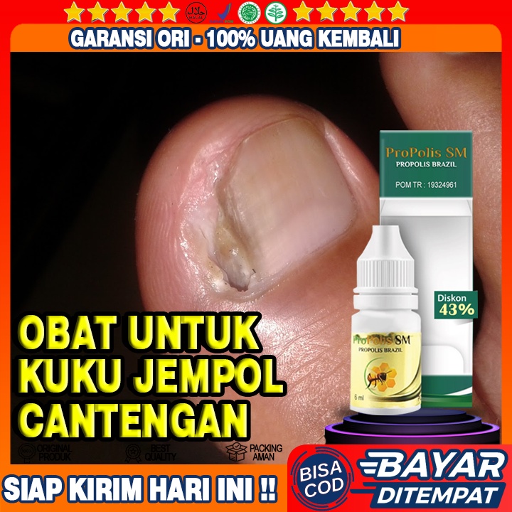 Obat Kuku Cantengan Di Jempol Kaki, Kuku Cantengan Di Jempol Tangan, Kuku Kekeongen Di Kaki