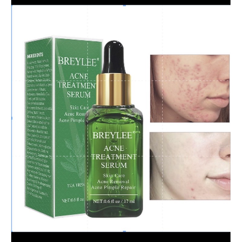 breylee acne treatment serum essence anti acne scar cream whiteninf