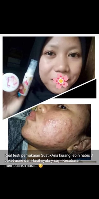 Cream Wajah Glowing BPOM Paket Premium Acne Pro by Suastikana Skincare Indonesia Untuk Jerawat-2
