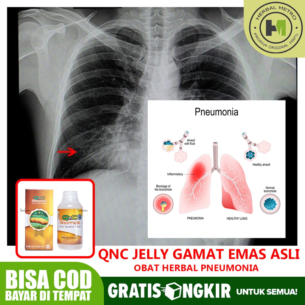 

Obat Herbal Pneumonia, Infeksi Paru, Paru2 Basah, TBC Paru QnC Jelly Gamat Jakarta Timur Bisa COD