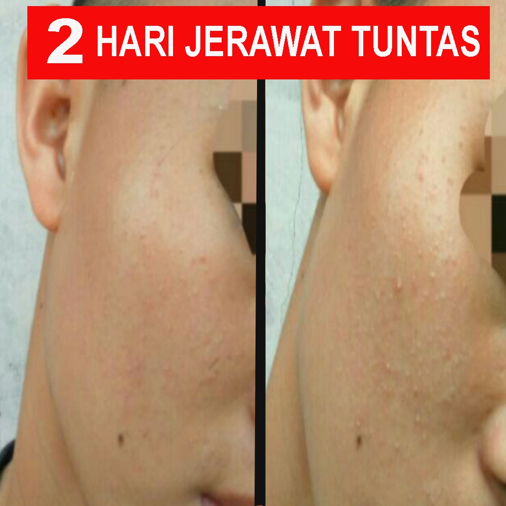 Obat Jerawat Bruntusan Paling Ampuh!! Sembuh Dalam 2 Hari Terbukti!