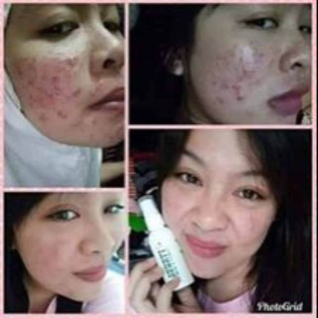 Beauty spray mnyembuhkan jerawat bekas jerawat cacar kudis kurap luka bakar
