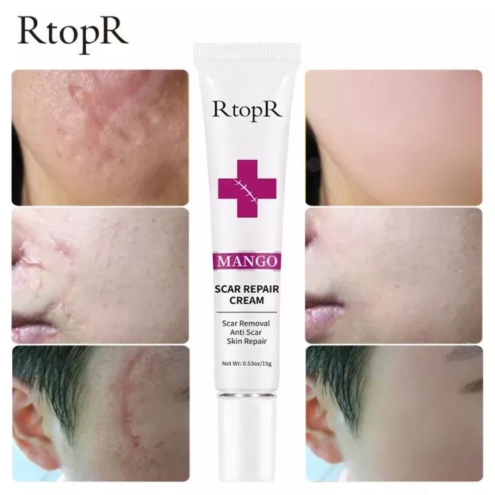 RtopR SCAR REPAIR CREAM Acne Scar Treatmen Repair Skin Care Stretch Burn Scar Remover Skin Repair Spots Body Skin Cream 15g