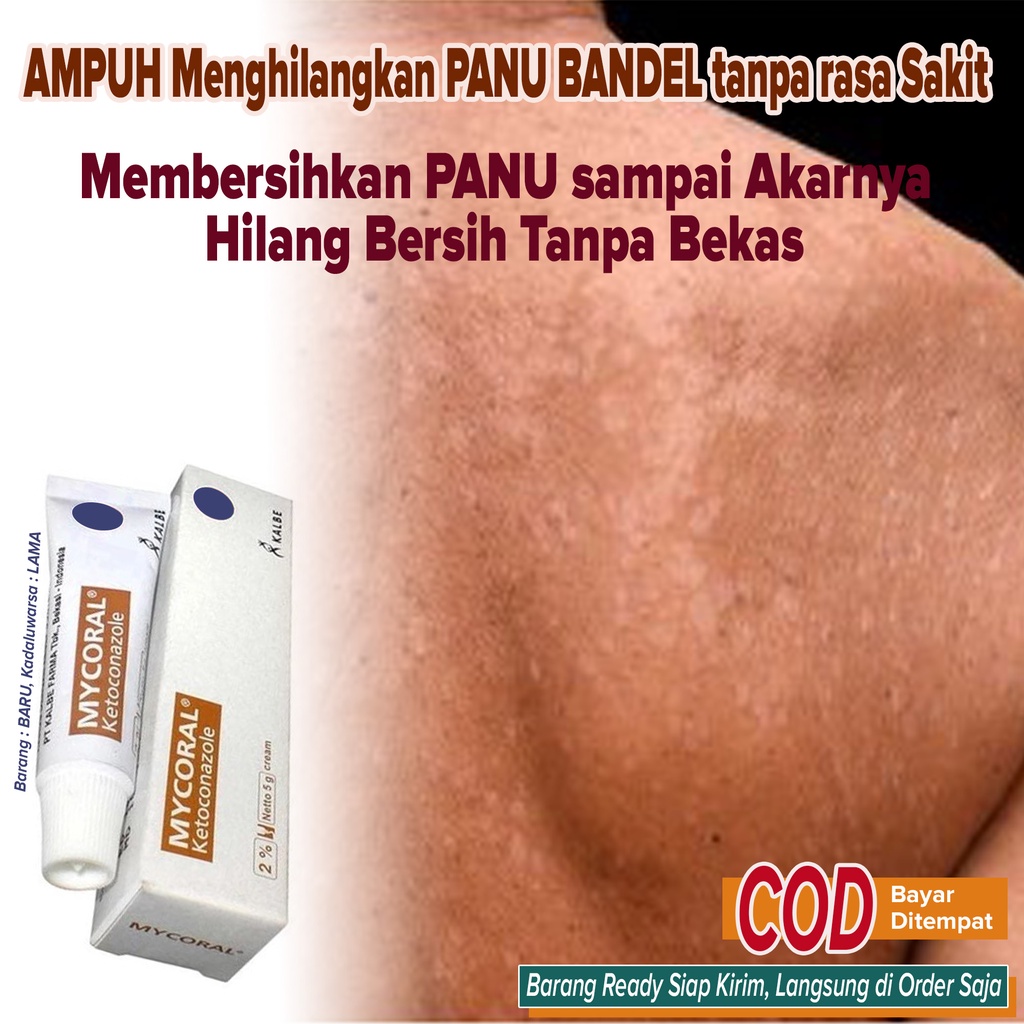 Best Seller Obat Salep Pembersih PANU Bandel AMPUH Penghilang PANU tidak panas tidak sakit di Kulit 