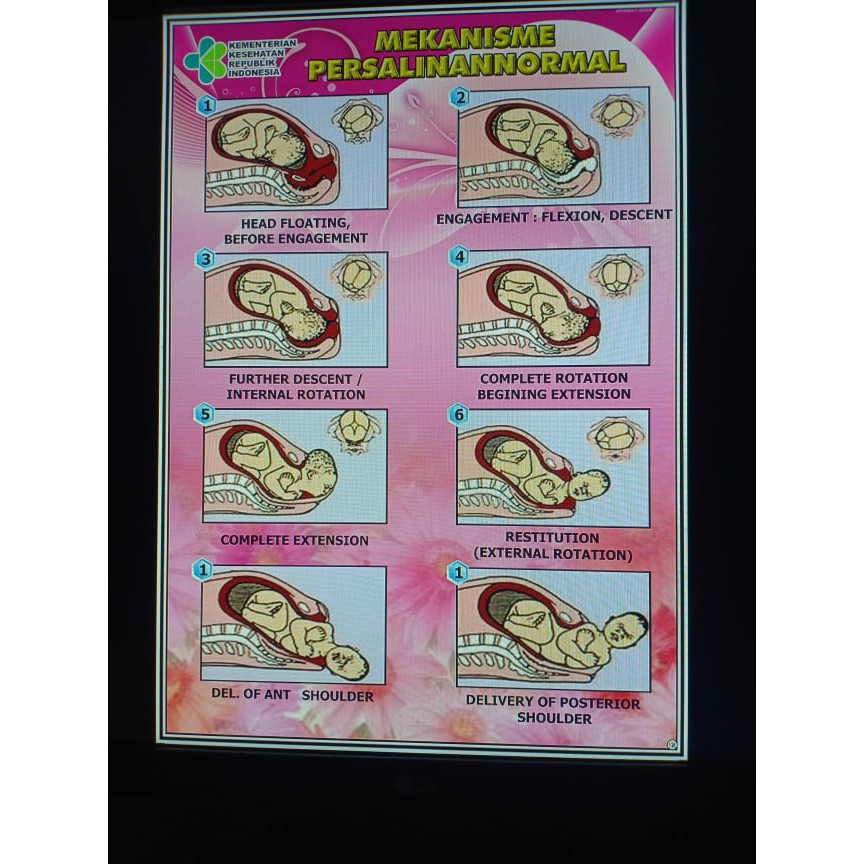 (136) POSTER MEKANISME PERSALINAN NORMAL