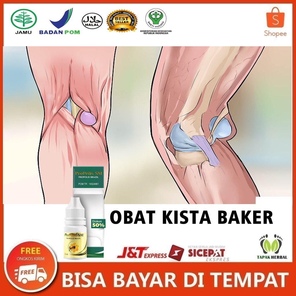 Obat Kista Baker, Obat Benjolan Di Lutut, Benjolan Di Belakang Lutut, Obat Radang Sendi Lutut, Obat 