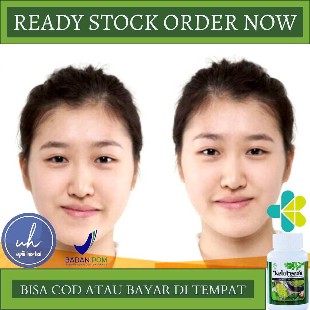 Obat Wajah Tidak Simetris, Obat Untuk Wajah Tidak Simetris, Obat Bibir Miring, Obat Perawatan Bell's