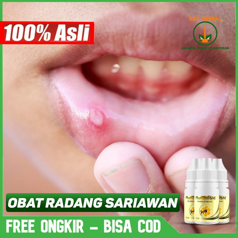 

Obat Radang Sariawan, Menahun, Tenggorokan Yang Aman Herbal Terlaris Propolis SM Bisa COD