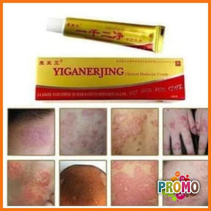 DISKON - Obat Eksim Gatel Kulit Jamur Herbal Yiganerjing Cream Gold Psoriasis