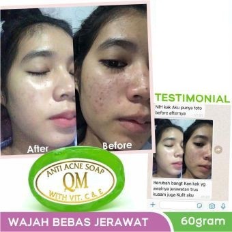 [ORI] QM SABUN ACNE HIJAU | Facial Soap Anti Acne Mengobati dan Mencegah Jerawat Membandel di Wajah