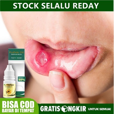 Obat Sariawan Menahun - Sariawan di Lidah - Sariawan di Tenggorokan - Sariawan di Bibir - Gusi