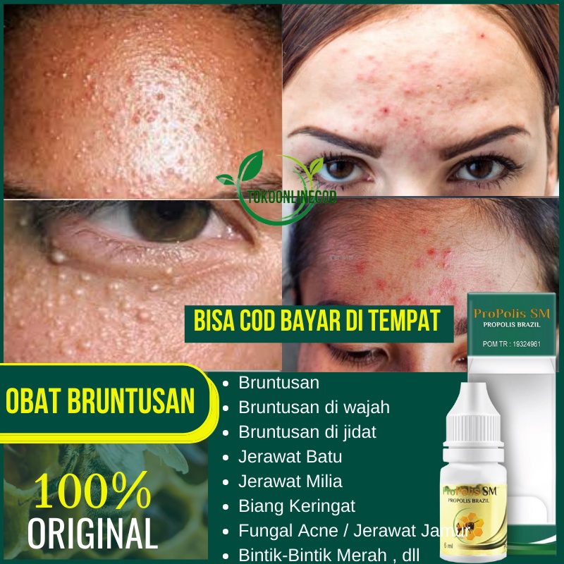Jual Obat Beruntusan, Bruntusan Pada Wajah, Bruntusan di Jidat