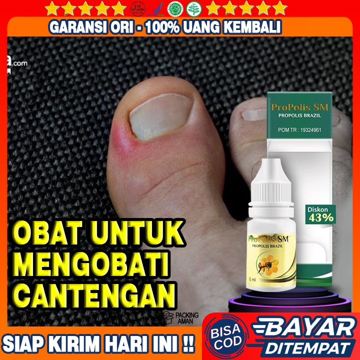 Obat Cantengan Jempol Kaki, Obat Kuku Bernanah,  Kuku Cantengan, Bengkak, Busuk,  Cantengan Parah