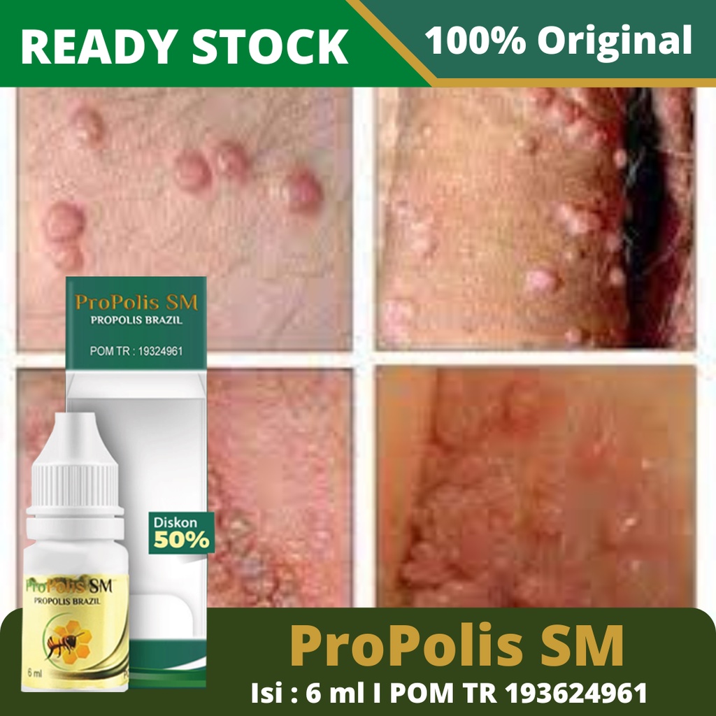 Obat Kutil Kelamin, Obat Kutil Kemaluan, Obat Penghilang Kutil di Alat Vital, Obat Perontok Kutil Untuk Pria dan Wanita Dengan ProPolis SM Brazil Asli Original